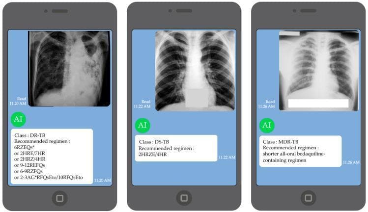 This infographic depicts a mobile-based diagnostic support system for tuberculosis (TB) management, presenting three separate smartphone interface frames. Each frame features a posterior-anterior (PA) chest X-ray (CXR) with AI-generated classifications and treatment regimens. The first image shows significant opacification and consolidation in the upper lung fields, classified as Drug-Resistant TB (DR-TB), with complex multidrug regimens listed. The second image displays relatively clear lung fields with normal vascular markings, classified as Drug-Susceptible TB (DS-TB), suggesting early-stage disease or a normal baseline, paired with a standard '2HRZE/4HR' regimen. The third image illustrates mild interstitial markings and apical opacities, classified as Multi-Drug Resistant TB (MDR-TB), recommending a shorter all-oral bedaquiline-containing regimen. This visual demonstrates the clinical application of deep learning algorithms in identifying TB drug-response phenotypes (DS, DR, MDR) and providing automated therapeutic guidance based on WHO protocols for infectious disease specialists and healthcare providers.