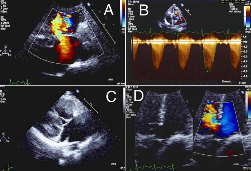 A composite of four echocardiographic images (A-D) demonstrating clinical findings consistent with Tetralogy of Fallot in an adult. (A) Color Flow Doppler imaging showing a membranous ventricular septal defect (VSD) with a significant right-to-left shunt, visualized as a turbulent, multicolored mosaic jet. (B) Spectral Continuous-Wave (CW) Doppler across the pulmonary valve, revealing a high-velocity systolic jet (reaching approximately -7.0 m/s), indicating severe pulmonic valve stenosis with dynamic obstruction. (C) Two-dimensional grayscale transthoracic echocardiogram in a four-chamber view illustrating marked right ventricular hypertrophy (RVH), characterized by thickened ventricular walls and altered chamber morphology. (D) Dual-panel view with and without Color Doppler demonstrating an overriding aorta, where the aortic root is positioned directly over the ventricular septal defect, receiving blood from both ventricles. This educational image illustrates key pathophysiological components of cyanotic congenital heart disease, relevant for cardiology and radiology training regarding anatomical abnormalities and hemodynamic shunt patterns.