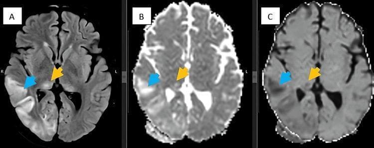Diagnostic axial brain MRI series comprising FLAIR (A), DWI (B), and ADC (C) sequences. The images demonstrate significant pathology in a patient diagnosed with anti-NMDA receptor encephalitis. Image A (FLAIR) reveals an area of hyperintense cortical signal in the right temporo-occipital region (blue arrow) alongside symmetric hyperintensity within the bilateral pulvinar nuclei of the thalamus (yellow arrow), a finding known as the 'pulvinar sign.' Correlation with diffusion-weighted imaging (B) and apparent diffusion coefficient maps (C) shows true restricted diffusion in these areas, characterized by high signal on DWI and corresponding low signal on ADC. These findings illustrate the classic neuroimaging manifestations of autoimmune encephalitis, where inflammatory processes lead to cytotoxic edema and cortical ribboning. The series is used to teach diagnostic imaging patterns for paraneoplastic and autoimmune central nervous system disorders.