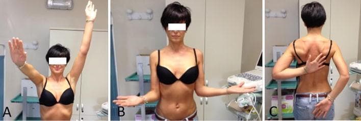 This clinical photograph series demonstrates the assessment of active range of motion (AROM) in a young female patient diagnosed with chronic calcifying tendinitis of the supraspinatus (SS) tendon and secondary shoulder stiffness (adhesive capsulitis). Panel A (anterior view) shows the patient attempting maximum shoulder elevation; the left arm is fully elevated while the right arm shows limited abduction to approximately 90 degrees with compensatory elbow flexion. Panel B (anterior view) illustrates bilateral external rotation with the elbows tucked at the sides, assessing for capsular restriction. Panel C (posterior view) demonstrates the 'Apley Scratch Test' or internal rotation assessment; the patient attempts to reach the dorsal midline of the back, highlighting significant asymmetry and restriction in the affected shoulder compared to the contralateral side. These views collectively visualize common clinical manifestations of a 'frozen shoulder' secondary to rotator cuff pathology, emphasizing the functional impact on elevation, abduction, and internal rotation.
