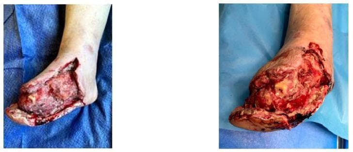 Clinical photographs of a diabetic foot with a large, complex surgical wound following excisional debridement and transmetatarsal amputation. The images show a deep, irregular wound bed spanning the dorsal and medial aspects of the foot. The tissue composition is heterogeneous, featuring areas of beefy red granulation tissue interspersed with patches of yellowish slough and fibrin. Some deep structures, potentially including exposed bone or fascia, are visible. The wound margins are irregular, exhibiting erythema and edema indicative of localized inflammation. Areas of clotted blood and dark, devitalized tissue are present, reflecting the immediate post-debridement state before Vacuum-Assisted Closure (VAC) therapy. The periwound skin shows signs of chronic peripheral arterial disease and venous insufficiency, including discoloration, pallor, and mottled skin distal to the ankle, suggesting compromised regional circulation. This visual illustrates the surgical management of critical limb ischemia and diabetic foot ulcers in an educational context.