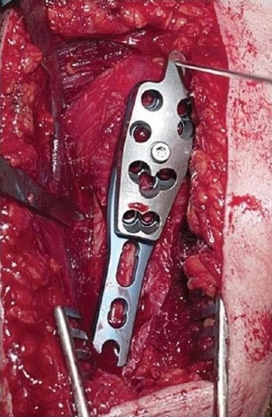This clinical photograph shows an intraoperative view of an orthopedic surgical procedure, specifically the fixation of a proximal humerus fracture using a PHILOS (Proximal Humeral Internal Locking System) plate. The surgical site is exposed via a deltopectoral approach, revealing red muscle fibers and deep soft tissue. A metallic locking plate is positioned vertically against the bone. The proximal part of the plate is wider, featuring multiple circular screw holes for multi-directional locking in the humeral head, while the distal shaft is narrower with elongated slots. A thin metallic guide wire is inserted through a hole at the top of the plate to establish the correct implant height and orientation, preventing subacromial impingement. Surgical retractors are visible at the bottom and sides of the wound, maintaining exposure. The image demonstrates key steps in orthopedic trauma surgery: fracture reduction, plate positioning, and the use of temporary k-wires for anatomical alignment before definitive screw fixation.