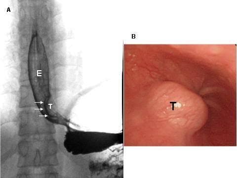 This composite medical image displays a case of esophageal leiomyoma through two modalities: diagnostic radiology and endoscopy. Panel A is a contrast esophagogram (barium swallow) showing an intramural tumor (T) in the distal esophagus (E) near the gastroesophageal junction. The lesion presents as a smooth, well-defined filling defect with sharp angles at its superior and inferior borders, characteristic of a benign intramural mass. Panel B is an intraluminal endoscopic photograph of the same tumor (T). It reveals a submucosal, rounded, protruding mass with an intact, smooth overlying mucosal surface, which is typical for a leiomyoma. The image illustrates key diagnostic features used to differentiate benign mesenchymal esophageal tumors from malignant mucosal lesions. These findings are clinically significant for planning surgical enucleation, often performed via video-assisted thoracoscopic surgery (VATS).