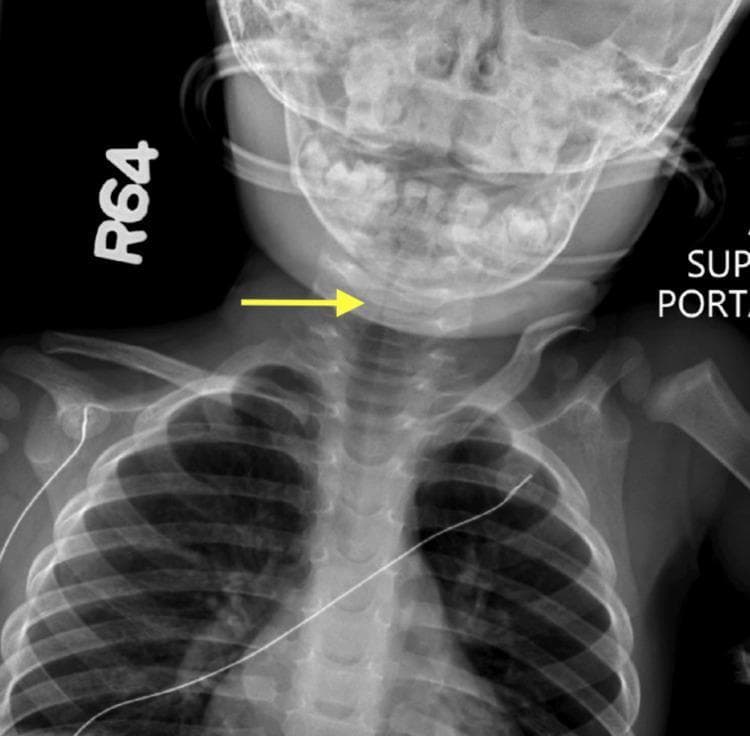 This diagnostic image is a posterior-anterior (PA) neck and upper chest radiograph of a pediatric patient. The central clinical finding is the classic 'steeple sign,' characterized by subglottic narrowing of the airway as it approaches the larynx, indicated by a yellow arrow. This tapering morphology represents edema in the subglottic region, commonly associated with viral laryngotracheobronchitis (croup). Beyond the focal subglottic stenosis, the radiograph demonstrates diffuse tracheal narrowing extending into the upper thoracic portion of the airway. Anatomical structures visible include the base of the skull, the cervical spine, bilateral clavicles, and the superior ribs. The soft tissues of the neck appear unremarkable except for the compromised airway lumen. This image serves as a key educational example of pediatric airway obstruction and the radiological manifestations of inflammatory subglottic stenosis in a clinical setting involving respiratory distress.