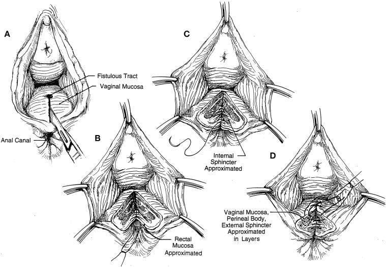 This medical illustration is an anatomical diagram and surgical flowchart depicting the sequential steps of a layered closure for a rectovaginal fistula. The series consists of four panels (A-D) showcasing the surgical repair from a lithotomy perspective. Panel A identifies the initial pathology, labeling the fistulous tract, vaginal mucosa, and anal canal, with a scalpel indicating the site of incision. Panel B demonstrates the first stage of reconstruction with the rectal mucosa being approximated using interrupted sutures. Panel C shows the subsequent repair layer, highlighting the approximation of the internal anal sphincter. Finally, Panel D illustrates the final layered closure involving the vaginal mucosa, perineal body, and external anal sphincter. The diagram emphasizes the importance of anatomical realignment and multilayered suturing to ensure structural integrity and functional recovery of the pelvic floor and anal sphincter complex.