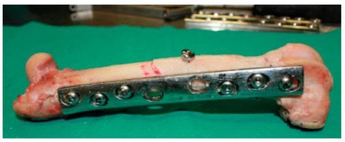 This clinical photograph displays an ex vivo femoral shaft undergoing internal fixation for a simple oblique fracture, serving as an educational example of orthopedic osteosynthesis. The primary stabilization is achieved using a shiny, metallic 8-hole Dynamic Compression Plate (DCP) contoured to the lateral aspect of the bone. The plate is secured with six bicortical screws positioned across the proximal and distal segments, acting in a neutralization function. Notably, an independent lag screw is placed perpendicularly across the fracture line to provide dynamic compression and enhance mechanical stability. The bone specimen exhibits a smooth cortical surface with visible reddish staining near the epiphyses, indicating the presence of vascularized tissue or residual soft matter. The arrangement demonstrates key principles of fracture management, including anatomical reduction and stable internal fixation to facilitate secondary bone healing. This image is relevant for surgical training and biomechanical study of plate-and-screw constructs in long bone fractures.