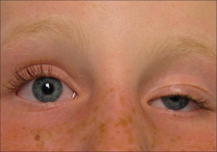 This clinical photograph shows a close-up, frontal view of a pediatric patient's periorbital region, demonstrating unilateral congenital ptosis of the left upper eyelid (noted as the eye on the viewer's right). The affected eyelid displays significant drooping, with the superior eyelid margin positioned notably lower than the contralateral side, partially obscuring the visual axis and decreasing the vertical palpebral fissure height. In contrast, the patient's right eye (viewer's left) shows a normal eyelid position with the margin resting at the superior limbus. A compensatory eyebrow elevation is visible on the affected side, where the left brow is positioned slightly higher than the right, suggesting recruitment of the frontalis muscle to assist in eyelid elevation. The patient exhibits fair skin with prominent ephelides (freckles) across the malar and nasal regions. This image serves as a classic educational example of blepharoptosis, emphasizing the comparison between normal eyelid anatomy and pathological drooping, as well as the associated secondary forehead muscle compensation.