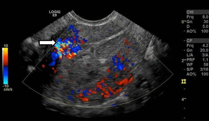 This color Doppler ultrasound image in the longitudinal plane displays the uterus of a 28-year-old female patient with a history of recent dilation and curettage (D&C). The image demonstrates enhanced myometrial vascularity (EMV), characterized by a focally increased color Doppler signal (indicated by a white arrow) spanning the full thickness of the anterior myometrium. This vascular signal extends directly into the endometrial cavity, which appears distended with isoechoic material. The color flow manifests as a complex mosaic of red and blue hues, indicating multidirectional, high-velocity blood flow within the myometrial wall. This clinical presentation and imaging finding are highly suggestive of retained products of conception (RPOC) or an acquired uterine arteriovenous malformation (AVM) secondary to pregnancy-related procedures. The imaging modality provides critical diagnostic information for differentiating between physiological postpartum changes and pathological vascular conditions requiring medical or surgical intervention.