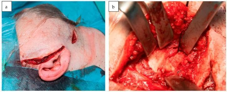 Clinical and intraoperative photographs documenting a surgical approach to temporomandibular joint (TMJ) reconstruction. Image (a) is a pre-auricular clinical photograph showing two distinct surgical incisions: a primary pre-auricular incision extending along the anterior border of the pinna and a secondary peri-angular mandibular incision in the submandibular region. The skin is prepped with surgical draping, demonstrating the dual-approach needed for joint access and mandibular fixation. Image (b) is a close-up intraoperative diagnostic photograph illustrating a deep surgical field. Multiple metallic retractors are positioned to expose the articulation fossa and condyloid region. The image demonstrates a state of partial bony ankylosis of the TMJ, characterized by irregular bone overgrowth and fibrous adhesions within the joint space. Visible tissues include cortical bone, underlying marrow elements, and surrounding vascularized soft tissue typical of oral and maxillofacial reconstructive procedures. These images collectively teach the surgical landmarks and pathological morphology associated with TMJ ankylosis and secondary overgrowth.