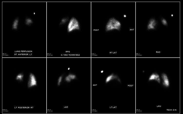 This diagnostic image is a nuclear medicine pulmonary perfusion scan consisting of eight static planar scintigraphic projections obtained using Technetium-99m labeled macroaggregated albumin (Tc-99m MAA). The views shown include Anterior (ANT), Posterior (POST), Right Lateral (RT LAT), Left Lateral (LT LAT), Right Posterior Oblique (RPO), Left Anterior Oblique (LAO), Right Anterior Oblique (RAO), and Left Posterior Oblique (LPO). The scan evaluates pulmonary blood flow distribution, with radiotracer uptake appearing as bright intensity against a dark background. A significant finding is a localized perfusion defect in the left lower lung zone, characterized by markedly decreased radiotracer uptake in the left base across multiple projections (notably ANT, POST, and LT LAT). In this clinical context, the defect corresponds to a significant elevation of the left hemidiaphragm and resultant basilar atelectasis, rather than a pulmonary embolism, as there is no mention of a ventilation-perfusion mismatch. The right lung shows relatively homogeneous and uniform tracer distribution throughout all zones. This imaging is used for evaluating suspected pulmonary embolism and diaphragmatic pathology in patients where contrast CT might be contraindicated.