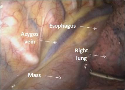 This endoscopic clinical photograph displays a intraoperative thoracoscopic view (VATS) of the right posterior mediastinum. The image highlights critical anatomical landmarks and their spatial relationships to a localized pathology. Centrally, the azygos vein is visible as a prominent bluish, tubular vascular structure. Parallel and adjacent to it lies the esophagus, appearing as a paler, vertically oriented muscular tube. A pathological mass is identified in the inferior aspect of the field, situated in the space between the azygos vein and the esophagus. The mass appears as a rounded, well-circumscribed, and highly vascularized structure with a smooth surface, identified in clinical context as hyaline-vascular Castleman disease. To the right of the surgical field, the parenchyma of the right lung is visible, demonstrating typical anthracotic pigment. This image serves as an educational reference for thoracic surgery and mediastinal anatomy, illustrating the typical presentation and surgical orientation for resecting posterior mediastinal tumors while avoiding injury to the azygos vein and esophagus.