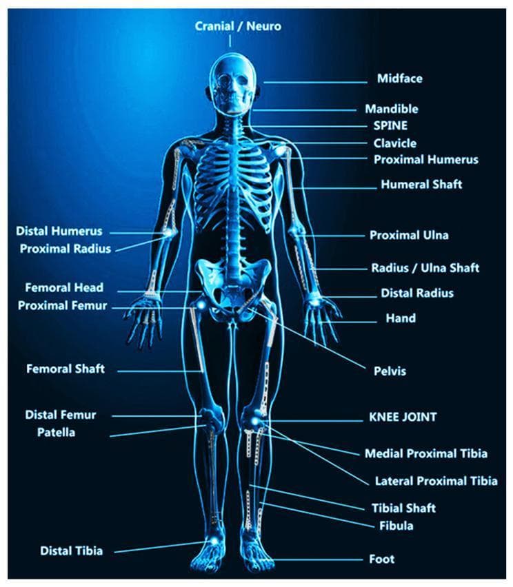 This medical illustration is an anatomical diagram presented as an anterior view of the human skeletal system, styled to resemble an X-ray radiograph. The image provides an educational overview of orthopedic implant locations within the musculoskeletal system. Key anatomical structures labeled include the cranial/neurocranium, midface, mandible, and the spinal column. The upper extremity labels identify the clavicle, proximal and distal humerus, humeral shaft, proximal radius and ulna, and the distal radius. The lower extremity sections highlight the pelvis, femoral head, proximal and distal femur, patella, and knee joint, as well as the medial/lateral proximal tibia, tibial shaft, fibula, and foot. Visually, the diagram overlays clinical imaging of common metallic orthopedic implants—such as bone plates, intramedullary nails, screws, and joint replacements—onto their respective anatomical sites. The primary educational focus is the clinical application and positioning of permanent and temporary fixation devices used in orthopedic surgeries for trauma, joint reconstruction, and managing conditions like osteoporosis.