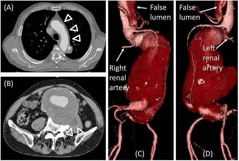 This composite of diagnostic images illustrates complex aortic pathology. (A) Axial contrast-enhanced CT of the chest shows an aortic dissection with a thrombosed false lumen (arrowheads) extending from the ascending aorta to the aortic arch. (B) Axial abdominal CT reveals a massive abdominal aortic aneurysm (AAA) with significant intramural thrombus. Evidence of chronic rupture is visible as erosion and remodeling of the adjacent lumbar vertebral body (arrowheads). (C and D) Volume-rendered CT angiography reconstructions provide a 3D anatomical overview from right and left anterior oblique perspectives. The images demonstrate the large infrarenal AAA extending to the common iliac arteries. Key vascular relationships are highlighted, including the patent false lumen near the origin of the right renal artery and the proximity of the left renal artery to the aneurysmal neck. These images represent typical findings in advanced aortic disease, focusing on Type A aortic dissection and juxtarenal AAA with chronic complications.