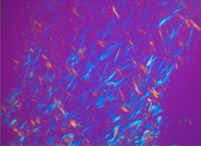This diagnostic image demonstrates compensated polarized light microscopy (CPLM) of a tissue sample, identified as an aortic plaque biopsy. The image displays the characteristic optical properties of monosodium urate (MSU) crystals. Numerous elongated, needle-shaped crystals are distributed throughout the field of view, exhibiting strong birefringence. Against a magenta or pinkish-purple background, the crystals appear in contrasting colors, primarily bright blue and yellow-orange, depending on their orientation relative to the axis of the compensator. This finding is classically associated with gout but here illustrates cardiovascular MSU deposition within vascular plaques. The image serves as an educational example of how polarized light microscopy is used to confirm the presence of urate crystals at a microscopic level, highlighting their distinctive morphology and birefringent signature for clinical pathology and rheumatology education.