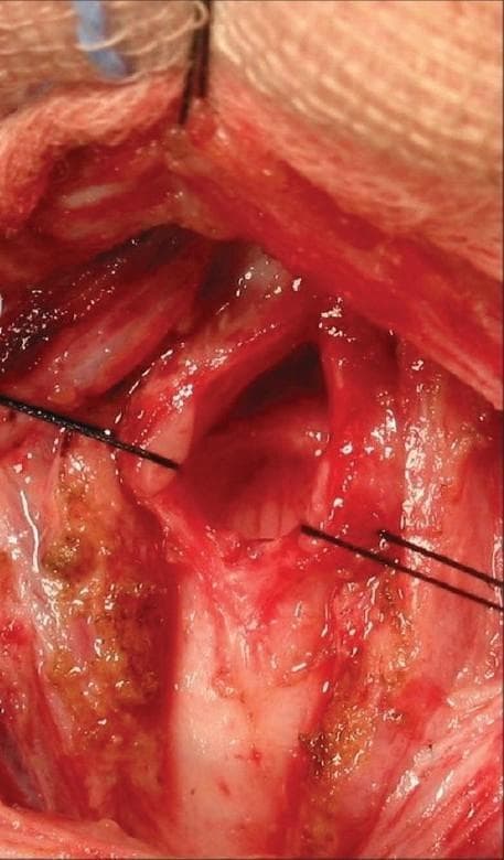 This clinical photograph captures an intraoperative view of an anterior cricoid split (ACS), a reconstructive surgical procedure used to treat subglottic stenosis. The surgical field reveals the laryngeal and upper tracheal airway structures after a vertical midline incision. Centrally, the cricoid and subglottic rings are visibly divided. A white, firm costal cartilage graft is positioned between the split edges to expand the airway lumen. The graft and surrounding cartilaginous tissue are secured with prominent black non-absorbable stay sutures to maintain the expanded position. The surrounding soft tissue is erythematous and vascularized, with evidence of minor cauterization and surgical trauma. This image serves as an educational example of laryngotracheal reconstruction, illustrating the use of structural grafts to increase airway diameter in patients with grade-dependent stenosis. The anatomical focus is the subglottic region, which is the narrowest portion of the airway and a common site for scarring after prolonged endotracheal intubation.