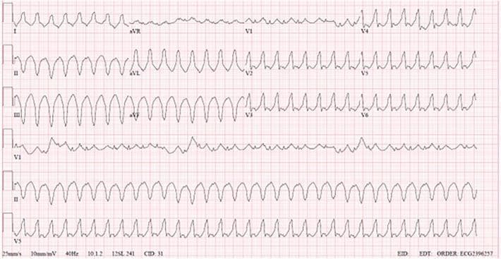 This diagnostic image is a 12-lead electrocardiogram (ECG) demonstrating a wide-complex tachycardia consistent with monomorphic ventricular tachycardia (VT). The tracing shows high-amplitude, wide QRS complexes with a rapid, regular rhythm. Key features include a superior axis (negative QRS in leads II, III, and aVF) and positive concordance across the precordial leads (V1-V6), where the QRS complexes are predominantly positive and uniform in morphology. The complexes exhibit a notched, somewhat sinusoidal appearance with prolonged ventricular depolarization time. Leads I, aVR, and V1 show an unstable baseline with erratic electrical activity and reduced signal amplitude, possibly indicating lead interference or specific conduction patterns in this clinical scenario. The ECG lacks visible P waves preceding the QRS complexes, and the overall morphology is indicative of an ectopic ventricular origin, often associated with structural heart disease such as dilated cardiomyopathy or post-surgical scars.