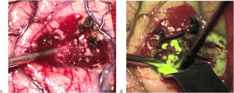 This comparative clinical photograph demonstrates the intraoperative visualization of a high-grade glioma (HGG) during neurosurgical resection using two different lighting modalities. Image (c) shows the surgical field under conventional white light, where the brain parenchyma, vascular structures, and the tumor bed are visible with typical anatomical colors; the tumor appears as heterogeneous dark and white tissue within a bloody surgical field. Image (d) displays the same surgical site under filtered light, utilizing fluorescence-guided surgery (FGS) techniques (likely 5-ALA induced protoporphyrin IX fluorescence). In this view, the malignant tumor tissue exhibits a vivid bright green fluorescence, significantly enhancing the contrast against the surrounding non-fluorescent normal brain tissue. Surgical instruments, including a metallic aspirator or probe, are seen positioned within the tumor cavity in both frames, indicating an active resection phase. This comparison illustrates how filtered light improves the identification of tumor margins and residual neoplastic tissue, facilitating a more complete extent of resection (EOR) compared to white light alone.