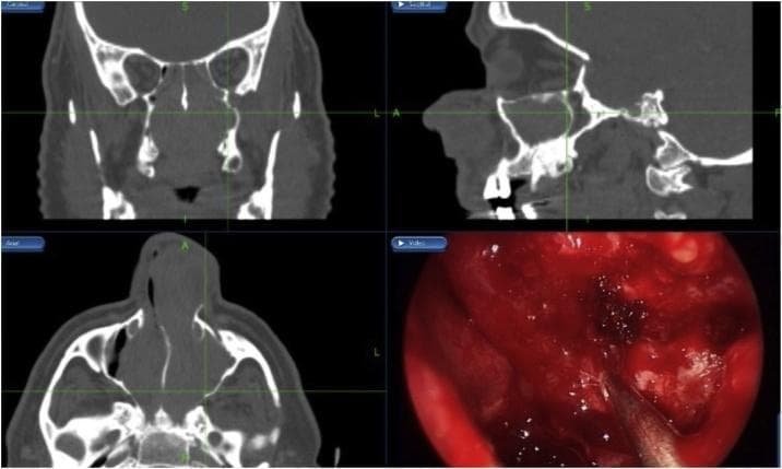 This composite medical image displays a case of sinonasal inverted papilloma managed through image-guided surgery. The layout includes three non-contrast Computed Tomography (CT) panels (coronal, sagittal, and axial views) and one intra-operative endoscopic photograph. The CT scans reveal extensive, homogenous soft-tissue opacities filling the bilateral nasal cavities, ethmoid sinuses, and maxillary sinuses, causing significant expansion and structural distortion. Green intersecting crosshairs across the CT panels denote the use of an intra-operative navigation system to localize a specific point in 3D space. The bottom-right panel shows the real-time endoscopic surgical field during a navigation-assisted bilateral medial maxillectomy. It demonstrates a view of the nasal mucosa, visible hemorrhage, and surgical instrumentation during tumor resection. This visual content illustrates the diagnostic imaging of sinonasal masses and the clinical application of surgical navigation in otorhinolaryngology for precise anatomical orientation during complex endoscopic sinus surgeries.