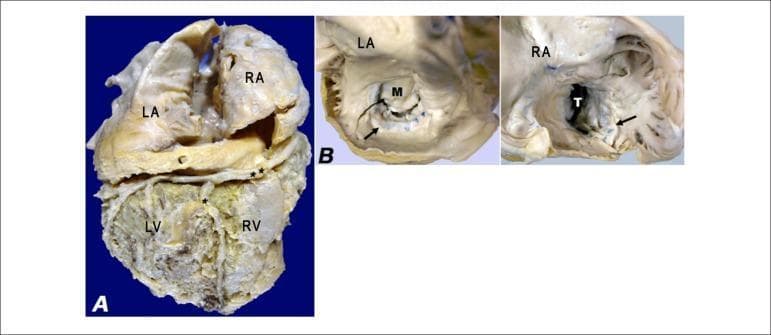 Two-panel clinical photograph of a gross pathology specimen illustrating cardiac hypertrophy and valvular changes. Panel A displays the diaphragmatic surface of the heart, showing massive dilatation of the left atrium (LA) and right atrium (RA) relative to the left ventricle (LV) and right ventricle (RV). The atrioventricular sulcus containing the right coronary artery (**) and the posterior interventricular sulcus containing the posterior interventricular branch (*) are visible. Panel B provides internal views of the left and right atria, highlighting bilateral endocardial thickening. Marked arrows indicate surgical sutures on the posterior cusps of the mitral (M) and tricuspid (T) valves from previous valvoplasties. The specimen demonstrates structural remodeling associated with chronic heart failure and restrictive cardiomyopathy, where the atrial chambers appear disproportionately enlarged compared to the ventricles. This image is educational for understanding cardiac gross anatomy, surgical landmarks in valvular repair, and pathological chamber remodeling.