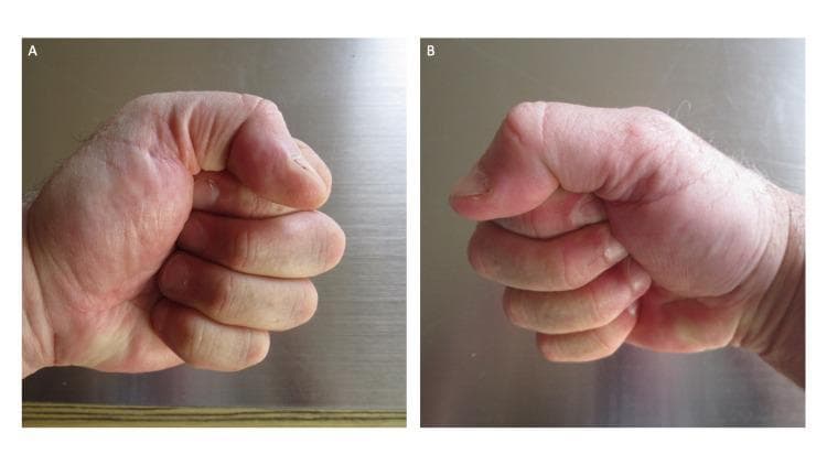 Clinical photograph showing two side-by-side images (A and B) of the left and right hands of a patient, demonstrating a negative 'fist sign.' Both hands are clenched into a tight, complete fist, where the fingertips are in direct contact with the ipsilateral palms and are nearly hidden from view. The metacarpophalangeal (MCP), proximal interphalangeal (PIP), and distal interphalangeal (DIP) joints exhibit a high degree of flexion. The visible skin on the dorsal surfaces and palmar creases appears normal, with no evidence of erythema, blanching, or edema. This clinical presentation illustrates the complete resolution of post-ambulatory swollen hands (POTASH), a condition associated with vigorous physical activity like running. The images serve as an educational comparison to the 'positive fist sign,' where significant hand edema prevents full flexion and contact between digits and the palm.