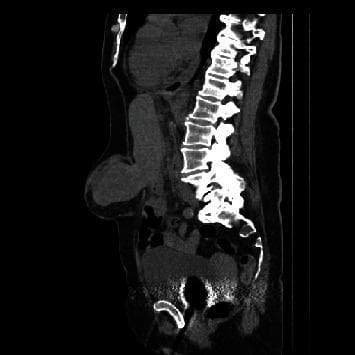 This diagnostic image is a non-contrast sagittal CT scan of the abdomen and pelvis. The image clearly displays the thoracolumbar vertebral column and sacrum as posterior landmarks. The primary finding is a large ventral abdominal wall defect at the supra-umbilical level, involving the linea alba. A significant portion of solid abdominal organ tissue, consistent with liver segment III, is seen herniating through the defect into a large epigastric hernia sac. The herniated liver tissue appears homogenous with density similar to the intra-abdominal liver parenchyma, contrasting with the lower-density subcutaneous adipose tissue. There is a visible bulge on the anterior abdominal wall corresponding to the hernia sac. This clinical imaging demonstrates a complex epigastric hernia with visceral content, highlighting the potential for liver herniation in severe ventral abdominal wall defects. The image is intended for educational purposes regarding diagnostic radiology and surgical anatomy of abdominal wall hernias.