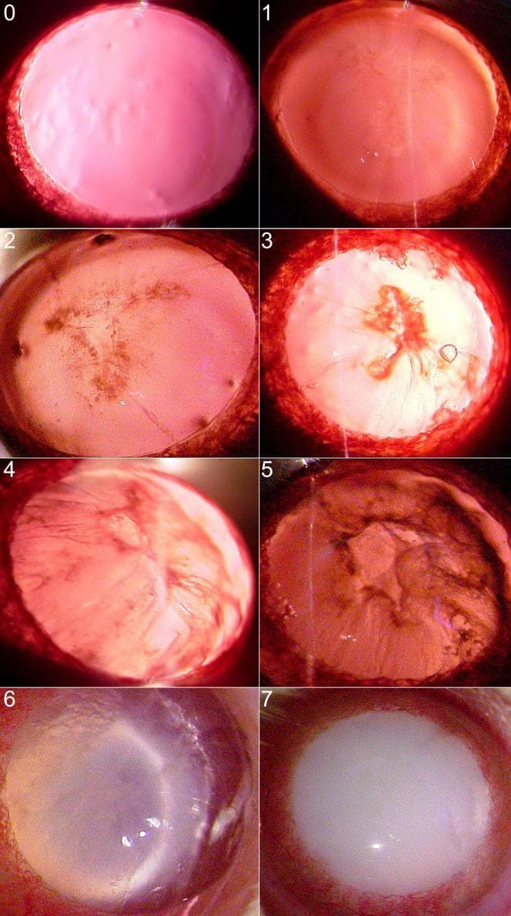 This composite of eight slit-lamp biomicroscopy clinical photographs illustrates the progression and grading of nuclear cataracts using the Oxford clinical grading system, ranging from Grade 0 to Grade 7. The images demonstrate the transformation of the crystalline lens from total transparency to complete opacification. Grade 0 shows a clear lens with a red reflex. Early stages (Grades 1–2) exhibit subtle nuclear density and visible wide sutures. Intermediate stages (Grades 3–5) show increasing nuclear densification and the formation of distinct cortical or nuclear clefts. Advanced stages (Grades 6–7) feature dense radial opacities and progress to a mature cataract characterized by total whole-lens opacification, which completely obscures internal structures and the posterior red reflex. This visual series is an educational tool for ophthalmology and optometry to standardize the assessment of lenticular opacity and cataract severity in clinical practice.