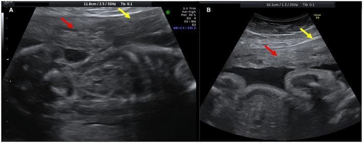 Side-by-side diagnostic obstetric ultrasound images demonstrating uterine adenomyosis during pregnancy at 20 weeks (Image A) and 30 weeks (Image B). The images highlight two primary sonographic markers of adenomyosis: hyperechoic islands and asymmetrical myometrial thickness. In Image A, the red arrow identifies prominent, focal clusters of increased echogenicity within the myometrium, described as hyperechoic islands. The yellow arrow points to a region of localized asymmetrical thickening of the uterine wall. In Image B, the same patient is shown at a later gestational age; the red arrow indicates that the hyperechoic regions have become more dispersed and less concentrated, while the yellow arrow shows the progression of the asymmetrical wall thickness. These images serve as a comparison of how myometrial architectural changes associated with adenomyosis evolve as the uterus expands during the second and third trimesters of pregnancy. Key educational concepts include the identification of heterogeneous myometrial echo texture and the longitudinal monitoring of uterine pathologies during gestation.