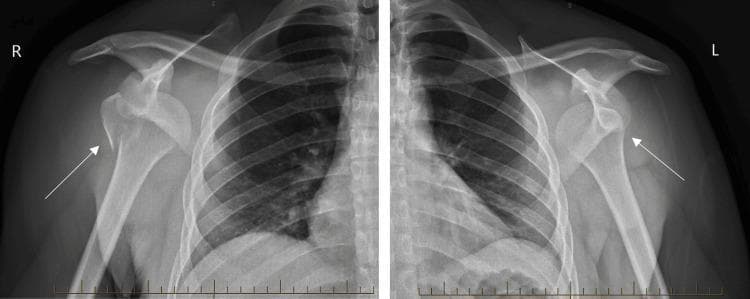 Anteroposterior (AP) X-ray radiographs of the right (R) and left (L) shoulders demonstrating bilateral anterior glenohumeral dislocations. In both views, the humeral heads are displaced anteriorly and inferiorly relative to the glenoid fossa. On the right shoulder, an arrow highlights a concomitant fracture of the greater tuberosity, characterized by a cortical disruption and slight displacement of the bone fragment. On the left shoulder, an arrow indicates the malpositioned humeral head beneath the coracoid process, consistent with subcoracoid dislocation. This clinical presentation is frequently associated with high-energy trauma or generalized tonic-clonic seizures. The images serve as an educational example of complex orthopedic injuries and the importance of checking for associated fractures in the setting of shoulder dislocations.