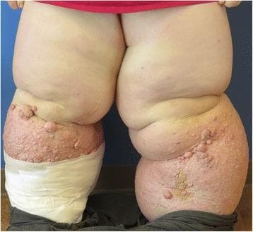 This clinical photograph displays a posterior view of Stage III bilateral lower extremity lymphedema in a young adult. Both legs exhibit massive, non-pitting edema resulting in profound distortion of normal anatomical contour and significant limb enlargement. The skin of the right lower extremity shows advanced integumentary changes, including hyperkeratosis, irregular nodular formations, and verrucous papules consistent with lymphostatic verrucosis. Patches of brownish-red discoloration and textural thickening indicate chronic dermal fibrosis and inflammation. The left lower extremity is partially covered with white compression bandaging or dressings, used for decongestive therapy. Deep skin folds are visible at the knees and thighs, representing areas prone to intertrigo. This case illustrates primary lymphedema praecox progressing to elephantiasis, a severe stage of lymphatic failure characterized by irreversible tissue changes and significant functional morbidity.
