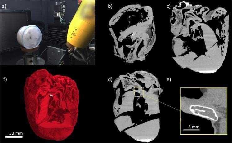 This composite image presents a high-resolution microCT analysis of a formalin-fixed heart, focusing on the identification of hyperdense structures within the cardiac skeleton. Panel (a) shows the physical setup of the microCT scanning equipment. Panels (b), (c), and (d) provide cross-sectional microCT slices of the cardiac anatomy. In these images, the cardiac chambers appear as hypodense (black) voids, while the myocardium, heart valves, and vascular walls are depicted in medium-density gray. Notably, a bright, hyperdense focal structure is visible in the valvular plane, located between the mitral and tricuspid valve regions. Panel (e) offers a magnified view of this hyperdense area, revealing a well-defined, mineralized structure with a thin, bright cortex and a less dense central region, characteristic of ectopic bone formation (os cordis) or mineralized cartilage. Panel (f) displays a 3D volumetric rendering of the heart in red, with the hyperdense bone-like structure highlighted in white within the internal anatomy. This visual material illustrates pathological mineralization and ectopic ossification within the fibrous cardiac skeleton, a significant finding in cardiovascular pathology and comparative anatomy.