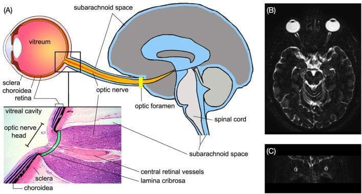 This composite educational graphic details the neuroanatomical continuity between the eye and the central nervous system. Panel A features a sagittal pathophysiology diagram illustrating the connection from the eyeball to the brain via the optic nerve. It highlights the layers of the eye (sclera, choroid, retina), the vitreum, and the optic foramen. A magnified histological inset shows the optic nerve head, lamina cribrosa, and central retinal vessels. Crucially, the diagram labels the subarachnoid space (SAS), demonstrating its continuity from the intracranial compartment to the orbital optic nerve sheath. Panel B provides clinical correlation with an axial T2-weighted MRI scan, where high-intensity (bright) signal represents cerebrospinal fluid (CSF) within the optic nerve SAS, contrasting against the dark optic nerves extending from the posterior globes. Panel C displays a coronal MRI slice further demonstrating the bilateral symmetry of the optic nerve sheaths. This material is designed to teach the physiological link between intracranial pressure and ocular health, relevant to specialties like ophthalmology, neurology, and radiology.