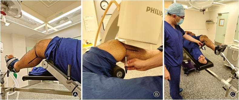 A three-panel clinical and procedural photograph (A, B, C) demonstrating standardized patient positioning and operating table setup for the surgical management of proximal tibia and distal femur fractures. The images show a patient in the supine position with the operative leg elevated and flexed. Key components include a transverse radiolucent post covered with a soft padded bolster positioned under the distal third of the femur to lift the femoral condyles and facilitate joint distraction. Panel A illustrates the operative foot secured in a foot support with straps, connected to the table via a metal bar and hinge joint, while the non-operative leg rests on a separate support. Panel B highlights intraoperative fluoroscopy using a C-arm imaging device positioned for an anteroposterior (AP) view of the knee joint. Panel C shows the surgical team identifying anatomical landmarks marked on the skin, demonstrating access to posteromedial and posterolateral structures. This setup is designed to optimize surgical exposure, facilitate fracture reduction through traction, and ensure clear radiological visualization during orthopedic procedures.