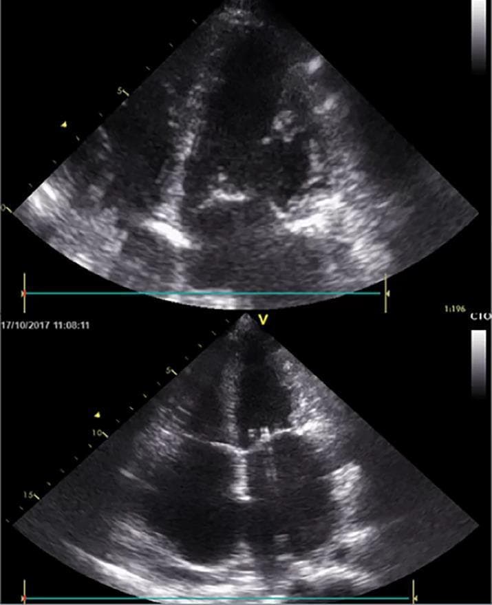 This diagnostic image consists of two grayscale transthoracic echocardiogram stills presented in an apical four-chamber (A4C) view. The visuals demonstrate a classic presentation of restrictive cardiomyopathy. Key anatomical features include severe biatrial enlargement, where both the left and right atria appear significantly dilated and disproportionately larger than the ventricles. In contrast, the left and right ventricular volumes remain within a relatively normal range with preserved cavity dimensions. The atrioventricular valves (mitral and tricuspid) are visible in their expected anatomical positions between the enlarged atria and the ventricles. The myocardium shows characteristic echogenicity associated with restrictive pathology. This visual is intended for medical education regarding heart failure with preserved ejection fraction (HFpEF) and the morphological differentiation between restrictive, dilated, and hypertrophic cardiomyopathies. It highlights the clinical significance of biatrial dilation as a hallmark of impaired ventricular filling and elevated filling pressures.