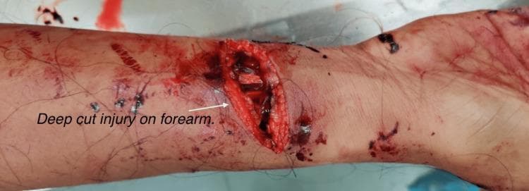 Clinical photograph of a deep, transverse incised wound located on the lower one-third of the volar aspect of the right forearm, near the wrist. The wound is gaping and exhibits sharply defined but blood-soaked margins, characteristic of a sharp force injury. Within the depth of the wound, anatomical structures are visible, including the severed ends of the flexor carpi radialis tendon and the radial artery. Significant hemorrhage is evident, with extensive blood staining, spatter, and streaks across the surrounding skin. Several small, punctate abrasions and dried blood clots are scattered distal to the primary injury towards the palm and wrist. This image serves as a forensic and clinical example of a life-threatening vascular injury resulting from sharp force trauma, demonstrating complete severance of a major peripheral artery and associated tendinous damage.