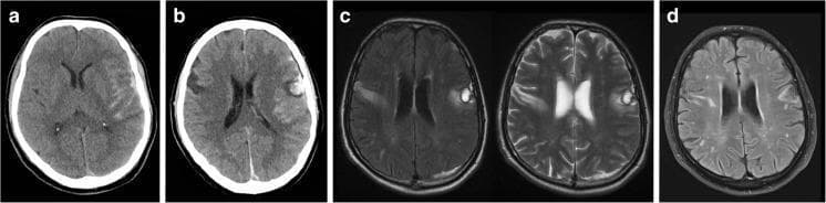 This neuroradiological composite displays the progression of traumatic brain injury leading to Foix-Chavany-Marie syndrome (FCMS). Panel (a) is an initial non-contrast axial CT scan showing traumatic subarachnoid hemorrhage within the left Sylvian fissure and over the left cerebral convexity. Panel (b), a follow-up CT at 48 hours, reveals a new hyperdense hemorrhagic contusion in the left frontal operculum and a corresponding hypodense lesion in the right inferolateral frontal region. Panels (c) and (d) provide axial MRI views. Panel (c) utilizes FLAIR and T2-weighted sequences at 2 weeks post-injury, clearly demonstrating hyperintense bilateral lesions localized to the frontal opercula, which are characteristic of FCMS. Panel (d) shows a progress FLAIR MRI at 13 months, illustrating the chronic persistence of these bilateral opercular signal abnormalities. The series highlights the superior sensitivity of MRI over CT in characterizing parenchymal opercular damage and its long-term sequelae in patients with persistent bulbar dysfunction.