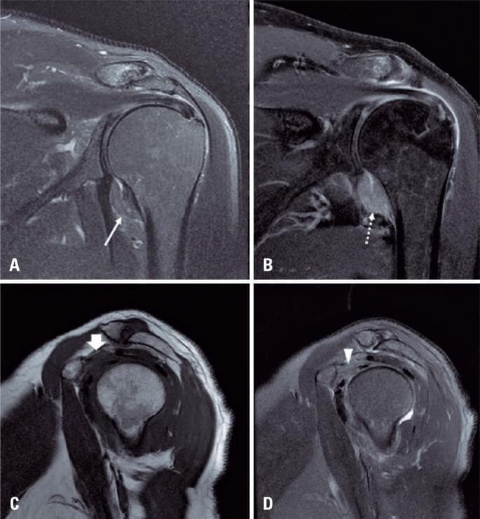 This diagnostic image set consists of four MRI views of a human shoulder illustrating the classic findings of adhesive capsulitis (frozen shoulder). Image A (coronal T2-weighted with fat suppression) and Image B (coronal T1-weighted post-gadolinium with fat suppression) demonstrate significant thickening of the glenohumeral joint capsule and pericapsular edema, particularly within the axillary recess. The post-contrast image (B) shows intense enhancement of the thickened capsule, indicating active synovitis and hypervascularity. Images C (sagittal T1-weighted) and D (sagittal T2-weighted with fat suppression) focus on the rotator interval. They reveal the characteristic obliteration of the normal subcoracoid fat pad by hypointense inflammatory tissue on T1 (arrow in C) and hyperintense edema on T2 (arrowhead in D). These imaging features are essential for confirming adhesive capsulitis in patients presenting with clinical shoulder stiffness and pain, allowing for the differentiation from other pathology such as rotator cuff tears or labral injuries.