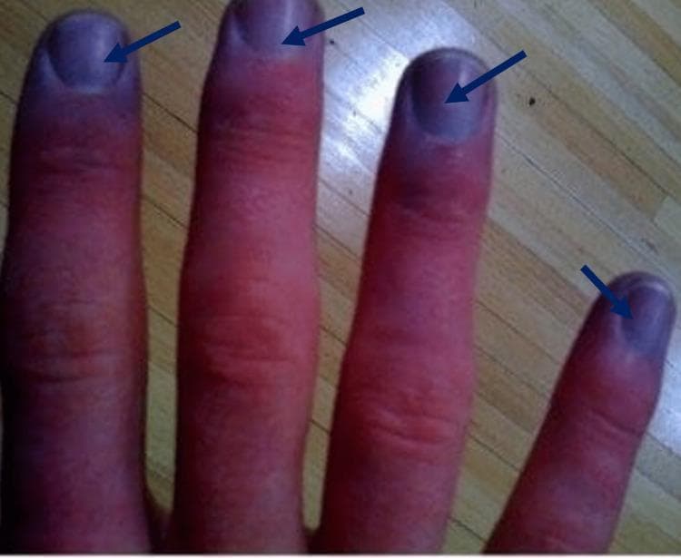 This clinical photograph displays the dorsal aspect of four human fingers, demonstrating classic signs of peripheral cyanosis. There is a distinct, localized bluish-purple discoloration (cyanosis) concentrated at the distal fingertips and involving the subungual regions (nail beds) of all visible digits, highlighted by dark blue arrows. The proximal and middle segments of the fingers exhibit a contrasting erythematous (reddish) hue. The skin appears intact without visible ulcerations, lesions, or significant edema. The nail plates maintain a normal morphology without evidence of digital clubbing. This visual finding is a hallmark of reduced peripheral oxygen saturation or impaired local circulation and is essential for medical students and clinicians in identifying hypoxia or vascular compromise. Target audience: medical students, nursing professionals, and emergency medicine practitioners.