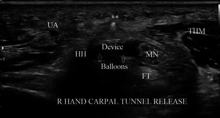 This transverse diagnostic ultrasound image captures a right hand during a carpal tunnel release procedure at the level of the hook of hamate. The image displays the carpal tunnel's internal anatomy and the precise positioning of a retrograde microknife within the transverse safe zone (TSZ). Key anatomical landmarks include the ulnar artery (UA) on the left, the hook of hamate (HH) presenting as a hyperechoic bony structure with posterior acoustic shadowing, and the median nerve (MN) on the right, which shows a characteristic speckled, hypoechoic oval appearance. Inferior to the median nerve are the flexor tendons (FT), while the thenar muscles (ThM) are visible on the far right. The surgical device is centrally located in the TSZ between the MN and HH; its deployed balloons, filled with saline, appear as hypoechoic rounded structures that physically displace neurovascular bundles to ensure a safe cutting path. A hyperechoic dot (marked with a double asterisk) represents the cross-section of the cutting blade positioned superiorly, ready to transect the transverse carpal ligament. This visual demonstrates the utility of real-time ultrasound guidance in identifying safe surgical margins during minimally invasive orthopedic procedures.