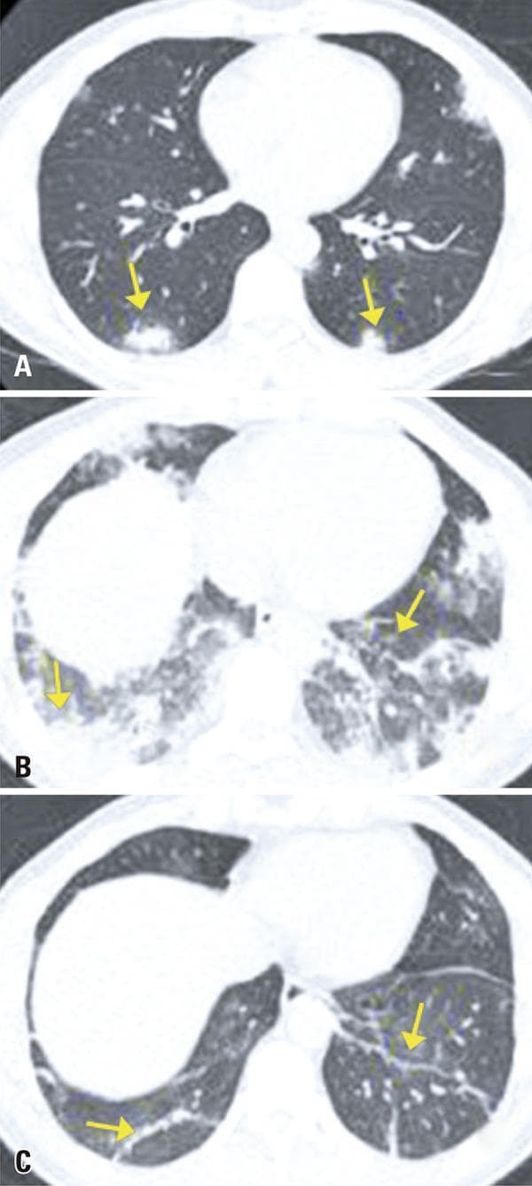 This diagnostic image set consists of three axial chest CT scans (A, B, and C) illustrating the temporal progression of COVID-19 pneumonia in a 44-year-old patient. Scan A (Day 1) demonstrates early-stage pathology characterized by multifocal, peripheral, and subpleural consolidations, primarily in the lower lobes. Scan B (Day 5) shows the peak 'progressive' phase, with a significant increase in the extent and density of pulmonary opacities. The predominant pattern is diffuse consolidation and ground-glass opacities occupying large portions of the lung parenchyma, obscuring normal vascular and interstitial markings. Scan C (Day 10) represents the 'absorption' or late phase, showing a marked reduction in the size and density of consolidations. Residual findings include sparse parenchymal bands and architectural distortion in the peripheral lower fields. This sequence serves as a clinical timeline for viral pneumonia evolution, highlighting the transition from focal inflammation to peak consolidation and subsequent partial resolution with residual linear scarring.