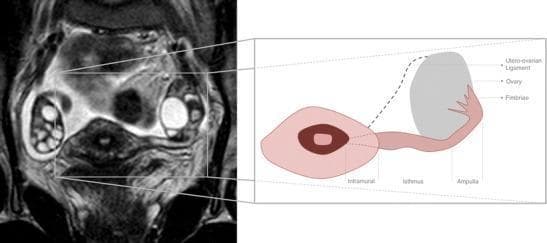 This composite educational graphic features a diagnostic MR image alongside an anatomical diagram, focusing on the female reproductive system. The left panel shows a T2-weighted coronal oblique MRI section of the pelvis from a 32-year-old female. Visible structures include a centrally positioned uterus, bilateral ovaries containing multiple high-signal intensity (bright) follicles, and the full longitudinal course of the left fallopian tube. The fallopian tube appears as a thin, convoluted, slightly hyperintense structure extending laterally toward the ovary. The right panel is a stylized anatomical illustration that maps and labels the segments of the fallopian tube based on the adjacent MRI. Labeled segments include the intramural (interstitial) portion within the uterine wall, the isthmus, the ampulla, and the fimbriae at the lateral infundibulum near the ovary. The diagram also identifies the utero-ovarian ligament. This visual is designed to teach normal pelvic anatomy and segmental division of the fallopian tubes, which are typically difficult to visualize on MRI unless surrounded by small amounts of peritoneal fluid.