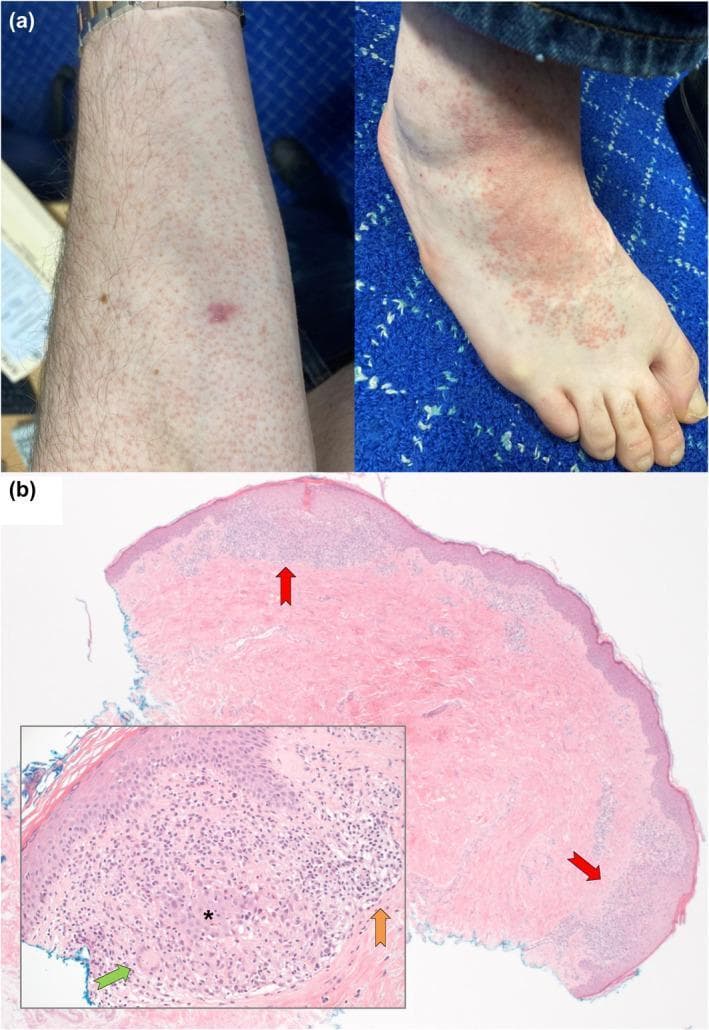 Educational panel illustrating clinical and histopathological findings of cutaneous sarcoidosis. Figure (a) contains two clinical photographs: the left shows diffuse orange-red micropapules on the forearm; the right displays similar lesions on the dorsal foot, which have coalesced into irregular, erythematous plaques. Figure (b) presents a histopathology section (H&E stain) at X25 magnification, identifying multiple well-formed, non-caseating granulomas in the superficial papillary dermis (indicated by red arrows). An inset at X250 magnification provides a high-power view of a single naked granuloma, characterized by a dense collection of epithelioid histiocytes (asterisk) and Langhans-type multinucleated giant cells (green arrow). A sparse peripheral rim of lymphocytic inflammation is also visible (orange arrow). The presentation demonstrates the typical morphological and cellular patterns used to diagnose granulomatous skin diseases.