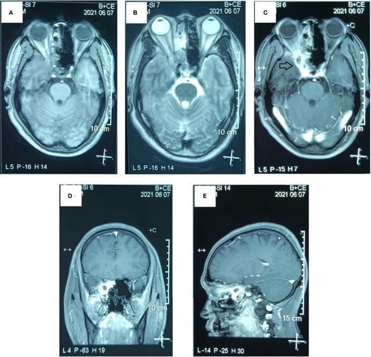Multi-planar postoperative Magnetic Resonance Imaging (MRI) of the paranasal sinuses and skull base following partial resection of a primary Ewing’s sarcoma of the sphenoid sinus. The figure displays five views: (A) Axial T1-weighted image (T1WI), (B) Axial T2-weighted image (T2WI), (C) Axial T1WI with contrast enhancement, (D) Coronal T1WI with contrast enhancement, and (E) Sagittal T1WI with contrast enhancement. The images visualize a residual soft tissue mass (indicated by a black arrow in panel C) centered in the right sphenoid sinus cavity. The residual tumor demonstrates irregular borders and extends into the right orbital apex and the lateral aspect/tip of the right orbit. Post-contrast images (C, D, and E) show heterogeneous enhancement of the mass, suggesting residual vascularized tumor tissue. Visible surgical changes include partial resection of the sphenoid and ethmoid sinus walls. The images provide clinical evidence for assessing surgical margins and planning adjuvant therapy for aggressive small round cell tumors in the head and neck region.