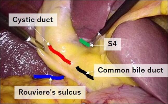 An intraoperative clinical photograph captured during a laparoscopic cholecystectomy, demonstrating key anatomical landmarks within the hepatocystic triangle (Calot’s triangle). The image shows the surgical field with labeled overlays identifying critical structures: the cystic duct (marked in red), the common bile duct (marked in black), the lower edge of the left medial liver segment or S4 (marked in green), and Rouviere's sulcus (marked in blue). Two laparoscopic graspers are visible, retracting tissue to expose the 'Critical View of Safety.' The cystic duct is shown extending from the gallbladder neck toward the common bile duct, while Rouviere’s sulcus appears as a distinct horizontal cleft on the liver surface, serving as an essential extrabiliary landmark to identify the plane of the common bile duct and prevent bile duct injury. The visual illustrates the spatial relationships necessary for safe dissection, particularly the orientation of S4 superior to the biliary structures and the horizontal alignment of the sulcus relative to the ductal anatomy.