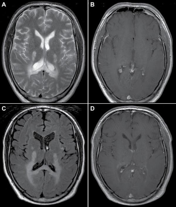 This composite diagnostic image presents axial brain MRI scans from a patient with adrenomyeloneuropathy (AMN) transitioning to cerebral adrenoleukodystrophy (cALD). Panels A (T2-weighted) and C (FLAIR) demonstrate progressive white matter disease. Initially, hyperintense signals are localized in the splenium of the corpus callosum and periventricular parieto-occipital white matter. Follow-up imaging in Panel C shows significant spatial extension of these lesions, appearing more confluent and diffuse. Panels B and D provide T1-weighted sequences with gadolinium contrast. While the initial scan (B) shows no pathological enhancement, the follow-up scan (D) reveals faint rim enhancement at the leading edge of the demyelinating lesion. This contrast enhancement is a critical clinical marker of active neuroinflammation and blood-brain barrier disruption. The series illustrates the radiologic hallmarks of X-linked adrenoleukodystrophy progression, including the characteristic posterior-to-anterior spread of demyelination and the transition to an active inflammatory stage.