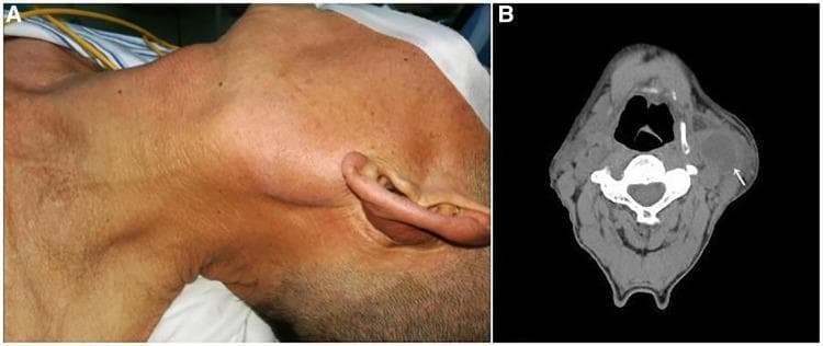 This composite image consists of a clinical photograph and a diagnostic CT scan illustrating a branchial cleft cyst in the neck. (A) A clinical photograph showing the left side of a patient's neck, where a large, prominent mass is visibly protruding from the skin in the upper cervical region. The overlying skin appears intact without obvious erythema. (B) An axial non-contrast CT scan of the neck at the level of the cervical vertebrae. It reveals a well-circumscribed, hypodense, ovoid mass (indicated by a white arrow) located on the left lateral aspect of the neck, deep to the platysma and lateral to the carotid sheath. The low-density center is characteristic of fluid-filled cystic structures. The lesion is located inferior to the parotid gland and anterior to the sternocleidomastoid muscle. The case illustrates the classic presentation of a branchial cleft cyst, which in this clinical context was diagnosed as a primary branchial cleft carcinoma (squamous cell carcinoma).