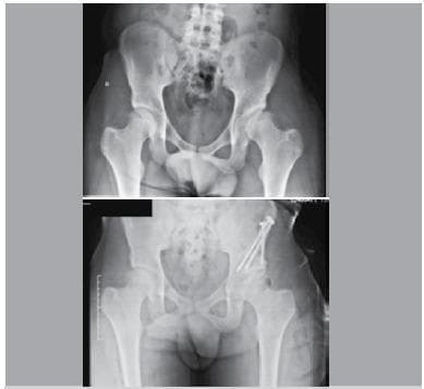 Anteroposterior (AP) pelvic radiographs demonstrating pre-operative and post-operative comparisons for a Periacetabular Osteotomy (PAO). The upper image shows developmental dysplasia of the hip (DDH), specifically on the left side, characterized by a shallow acetabulum and decreased lateral coverage of the femoral head, reflected by a low center-edge (CE) angle of 7 degrees. The lower image presents the post-surgical result where the left acetabulum has been reoriented to improve femoral head coverage, achieving an increased CE angle of 22 degrees. Two large metallic cortical screws are visible in the left ilium, providing surgical fixation of the osteotomized acetabular fragment. The anatomical reorientation is evident by the increased lateral and superior coverage of the 'sourcil' over the femoral head. Key structures visible include the pelvic ring, sacroiliac joints, bilateral hip joints, and the proximal femurs. This visual comparison illustrates the radiological objectives of PAO: correcting acetabular orientation to improve joint mechanics and prevent secondary osteoarthritis.