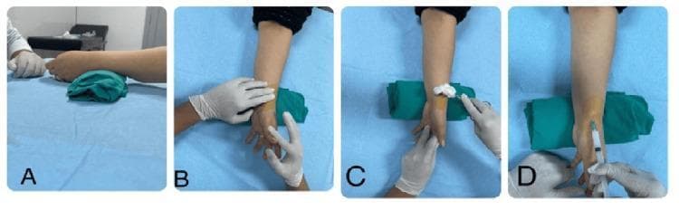 A four-panel clinical photographic sequence (A-D) demonstrating the step-by-step procedure for a corticosteroid injection into the first dorsal extensor compartment of the wrist, typically performed for De Quervain tenosynovitis. (A) Patient positioning: The wrist is placed in a neutral to slight ulnar deviation position, supported by a green folded towel for elevation on a sterile blue drape. (B) Palpation: A gloved clinician identifies the anatomical landmarks, specifically the radial styloid process and the tendons of the abductor pollicis longus (APL) and extensor pollicis brevis (EPB). (C) Site preparation: The radial aspect of the wrist is prepped with a sterile cleaning agent using a swab. (D) Administration: Intralesional injection is shown using a syringe with the needle angled at approximately 45 degrees, directed distal to proximal into the tendon sheath proximal to the radial styloid. The educational focus is on proper anatomical targeting, sterile technique, and needle trajectory for radial wrist interventions.