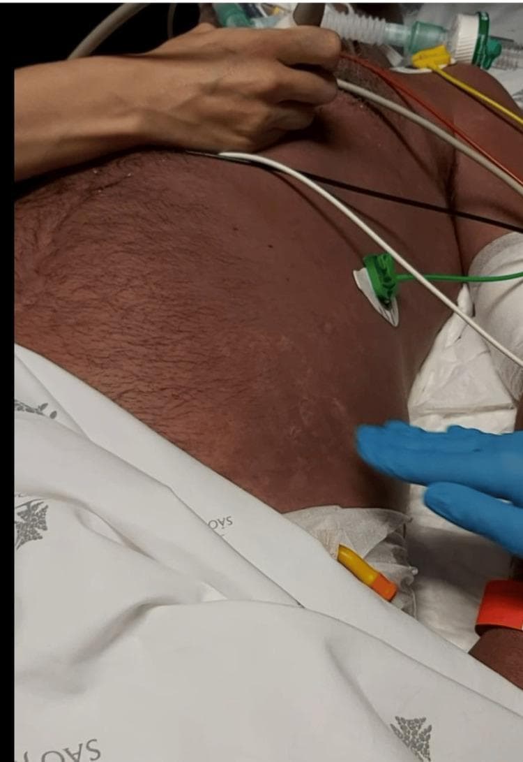 Clinical photograph of a patient's torso in a critical care setting, demonstrating an exuberant, diffuse erythematous rash. The skin exhibits a widespread, uniform reddish discoloration across the chest and abdomen. A notable feature is the blanching nature of the erythema, where the redness temporarily disappears under digital pressure, as demonstrated by the presence of a gloved hand and lighter patches in the lower left abdominal region. The rash appears macular and confluent without obvious vesicles, papules, or petechiae. Medical monitoring equipment, including ECG leads and tubing, is visible on the patient, indicating an acute clinical presentation. This visual manifestation is associated with streptococcal shock or toxic shock syndrome (TSS), representing a systemic inflammatory response. The image is used to teach medical students and residents about the dermatologic signs of sepsis and the physical examination technique of blanching in capillary-refill assessment.