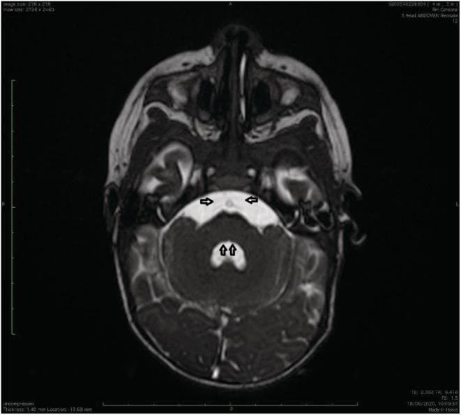 This diagnostic image is an axial T2-weighted MRI of the brain at the level of the pons and fourth ventricle, illustrating neuroanatomical abnormalities characteristic of Möbius syndrome. The image reveals a bilateral absence of the facial colliculi in the dorsal pontine tegmentum, indicated by vertical arrows, leading to an atypical 'inverted V' shape of the fourth ventricle. Furthermore, there is a radiologic absence of the abducens nerves (Cranial Nerve VI) along their expected cisternal trajectory from the pontomedullary junction, marked by horizontal arrows. The surrounding middle cerebellar peduncles and cerebellar hemispheres appear otherwise intact. These findings—the absence of the facial colliculus (formed by facial nerve fibers looping around the abducens nucleus) and the lack of visible abducens nerves—are pathognomonic radiological signs of brainstem hypoplasia involving the VIth and VIIth cranial nerve nuclei, correlating with clinical symptoms of congenital facial paralysis and impaired lateral eye movement.