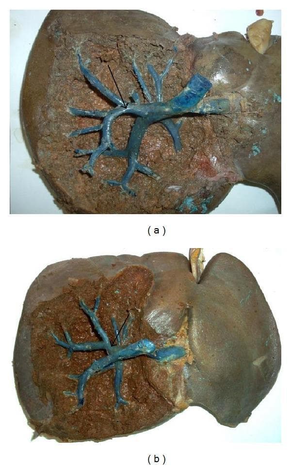 Two clinical photographs (a and b) of gross human liver specimens undergoing anatomical dissection to demonstrate the right sectional pedicles in relation to Rouviere's sulcus. Both images show a partially dissected liver where the smooth Glisson's capsule has been removed to reveal the underlying parenchyma. In image (a), the right posterior sectional pedicle is highlighted, while image (b) shows the right anterior sectional pedicle. In both specimens, the vasculature and biliary structures have been injected with a blue-colored resin or latex to enhance visualization of the branching patterns. The dissections highlight the intrahepatic location of these pedicles within the cleft (sulcus), which serves as an important surgical landmark for identifying the right hepatic pedicle during laparoscopic cholecystectomy or hepatic resection. Black arrows point to specific vascular branching points within the surgical plane. The images illustrate the topographical relationship between the portal triad components and the inferior surface of the liver.